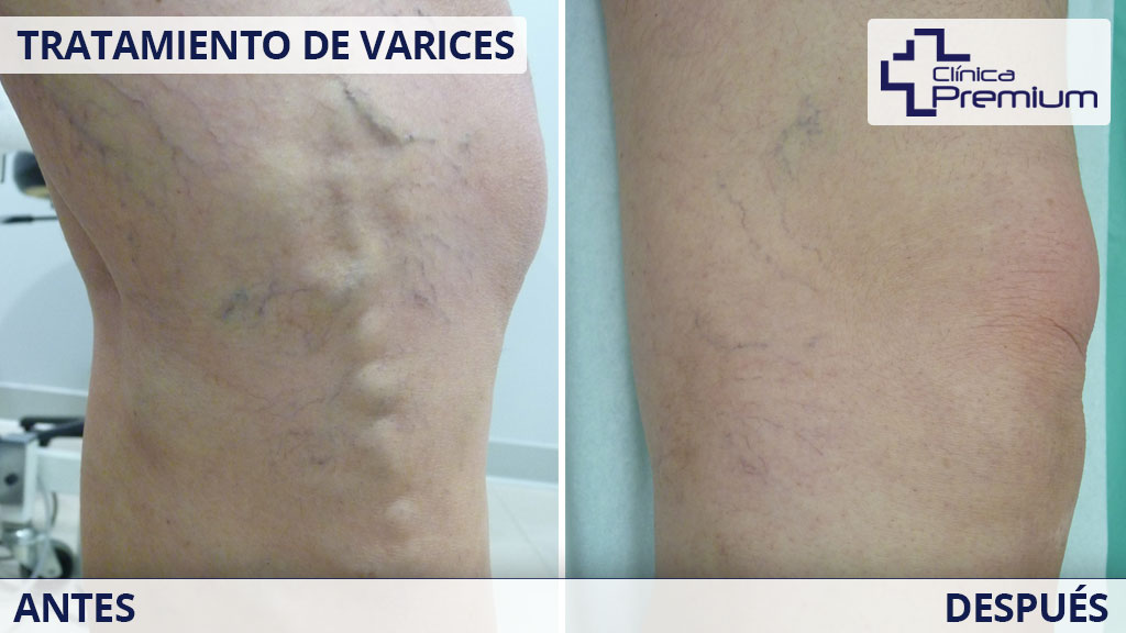 antes-despues-tratamiento-de-varices