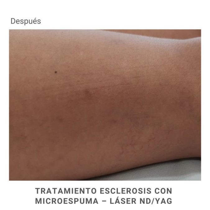 Varicose vein medical congress