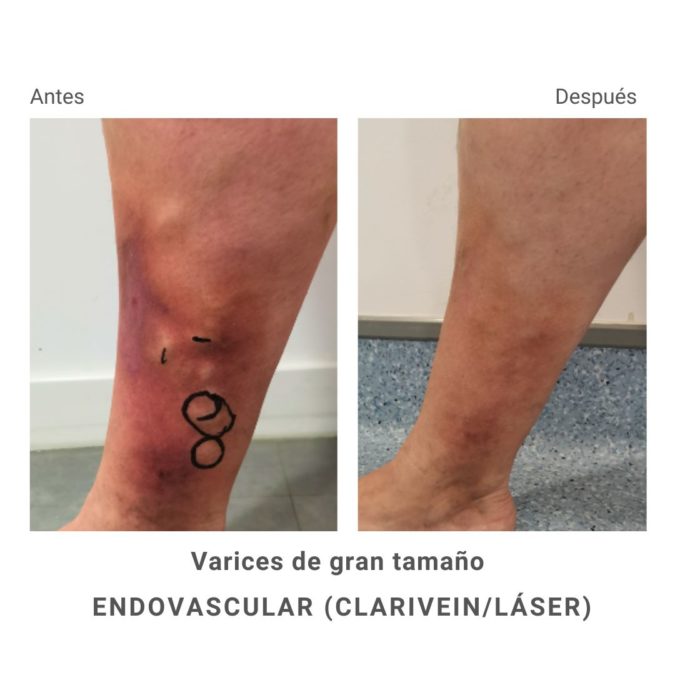Large varicose veins