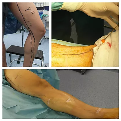 Endovascular treatment of varicose veins