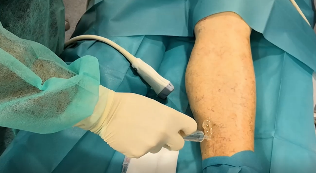Varicose veins in legs