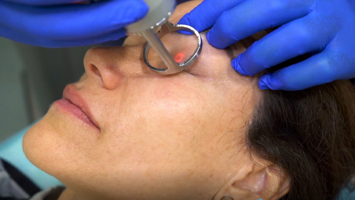 Facial laser treatment