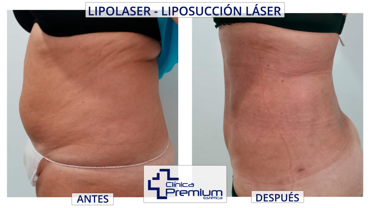 Laser lipolysis results